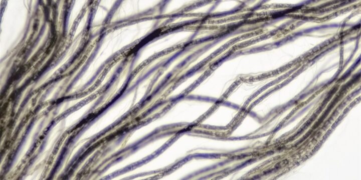 Forståelse af neuropati: Typer, symptomer og behandling